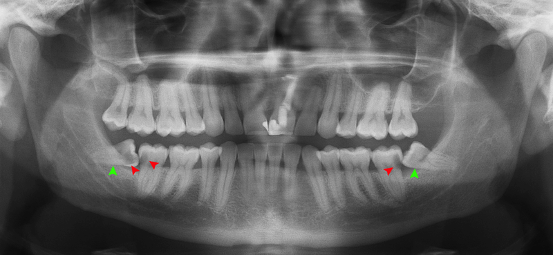 Wisdom tooth removal in Lahore